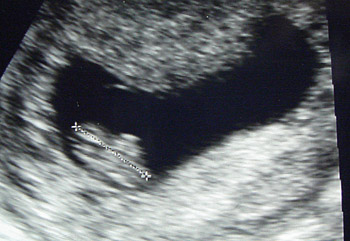 Ultrasound June 18 2008
